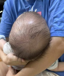 Bé có dấu hiệu méo, bẹt đầu