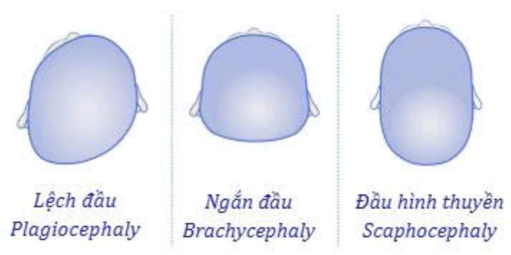 3 dạng biến dạng thường gặp ở trẻ