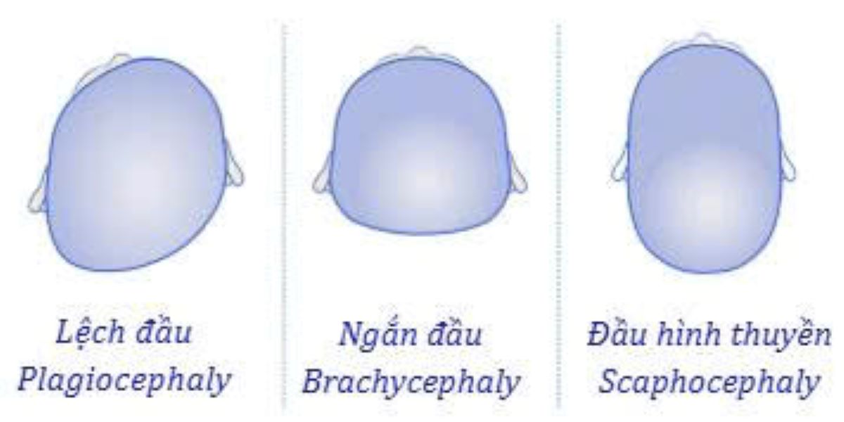 3 dạng biến dạng thường gặp ở trẻ