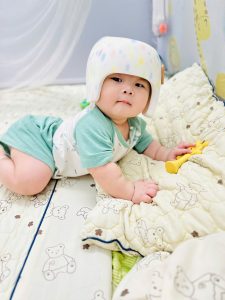 Ảnh hưởng của biến dạng hộp sọ đến sự phát triển của trẻ