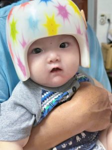 Hình ảnh trẻ sử dụng mũ chỉnh hình Hani Helmet